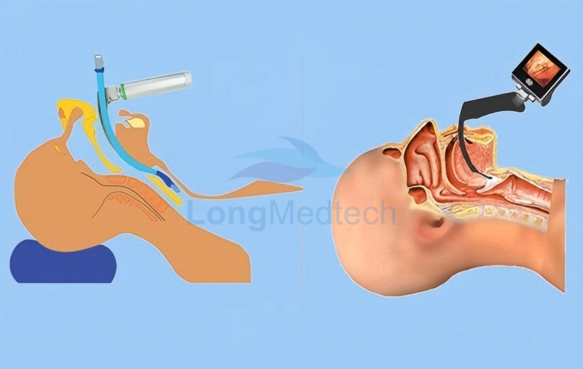 Pourquoi les vidéo-laryngoscopes sont importants