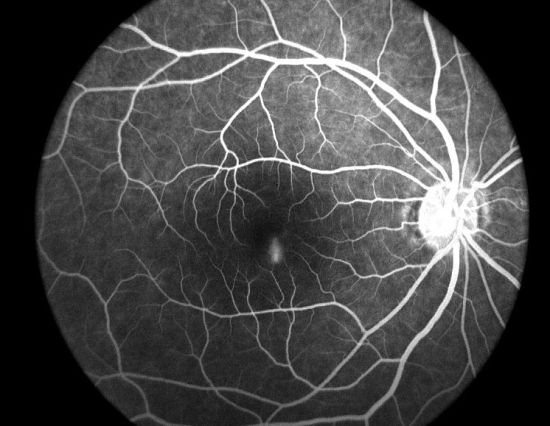 APS-B Equipo de oftalmología no midriática Cámara de fondo con función de angiografía con fluoresceína